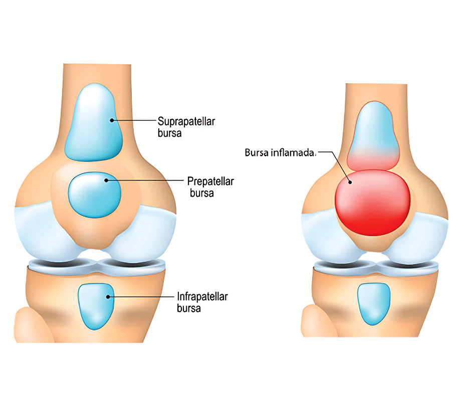 Dos rodillas mostrando una rodilla sana y la otra con la lesión